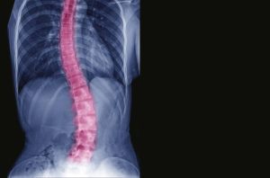 Symptoms Scoliosis